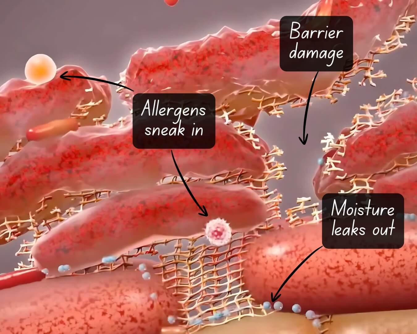 Barriera cutanea danneggiata: allergeni che entrano e umidità che esce